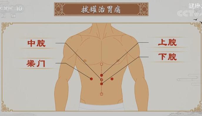 健康之路:抽气式拔罐20231107刘清国