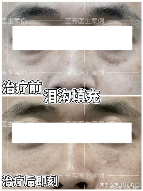 眼袋的形成与多种因素有关,主要包括以下几个方面:    眼部老化