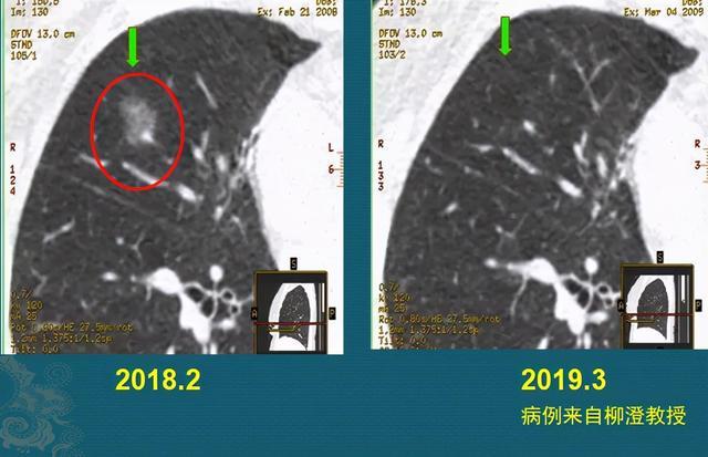 磨玻璃肺结节定期复查,会不会耽误治疗?医生带你看结节4种结局