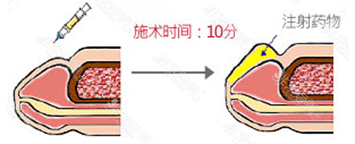 玻尿酸注射增大龟头示意图